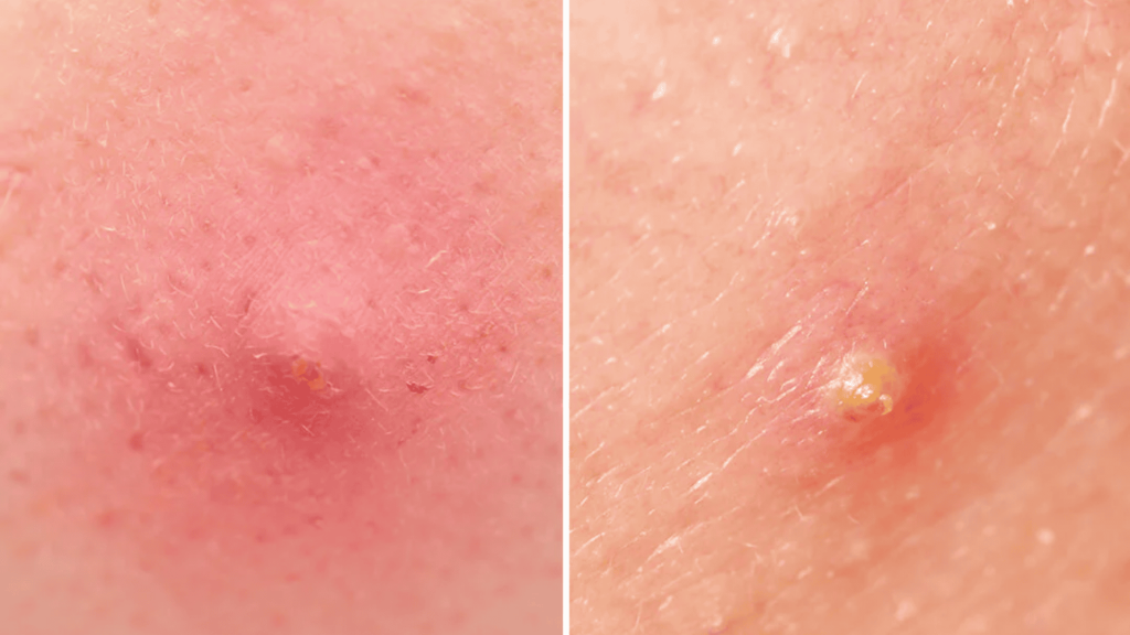Pustules and  Papules Forehead Acne
