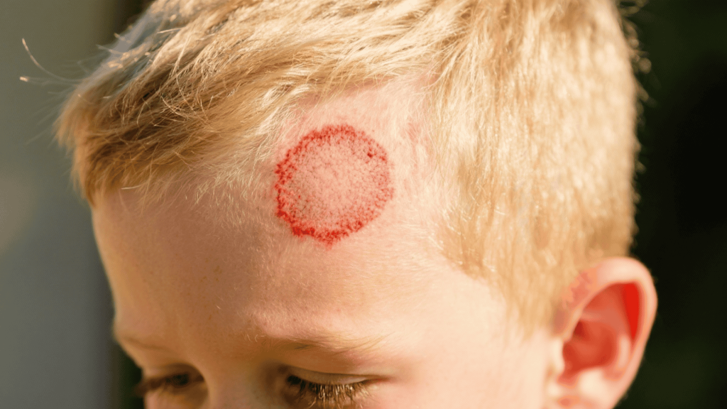 Ringworm