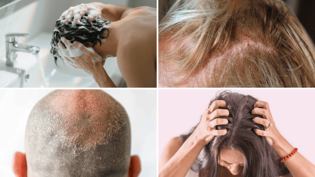 Scalp Sore