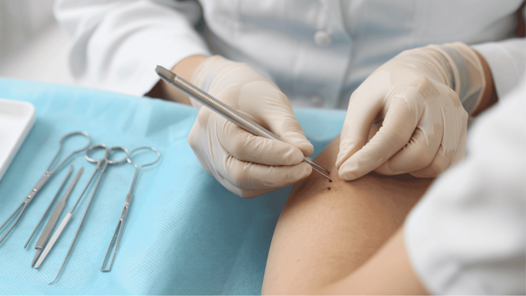 Surgical Excision
