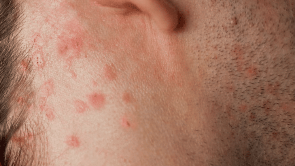 contact dermatitis