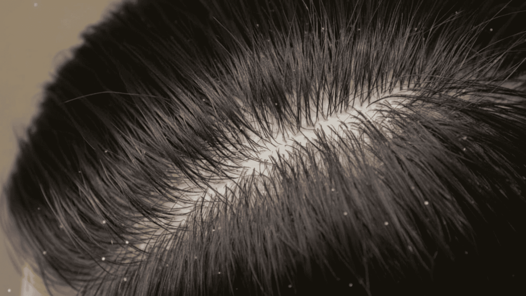 dandruff
