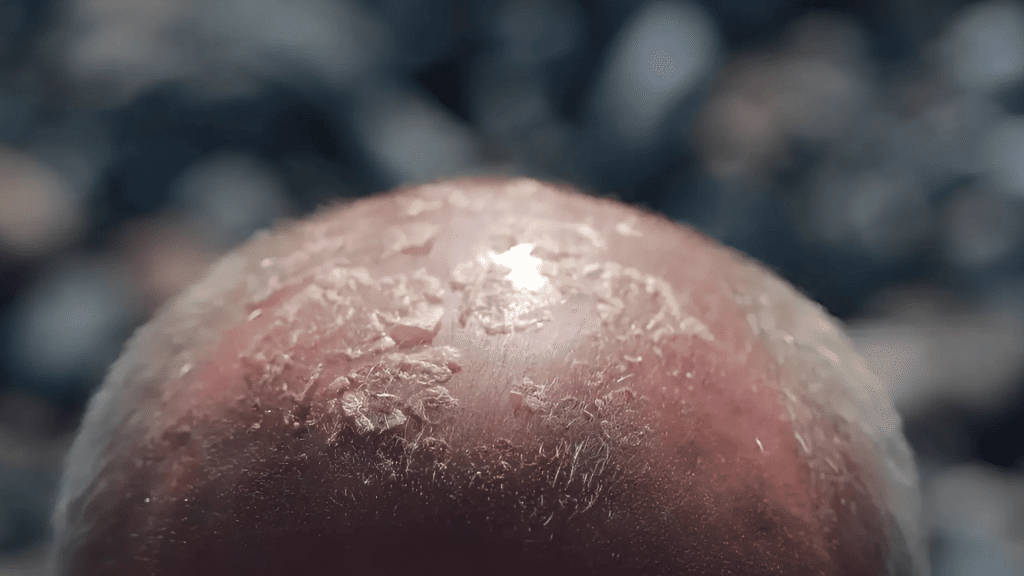 eczema.