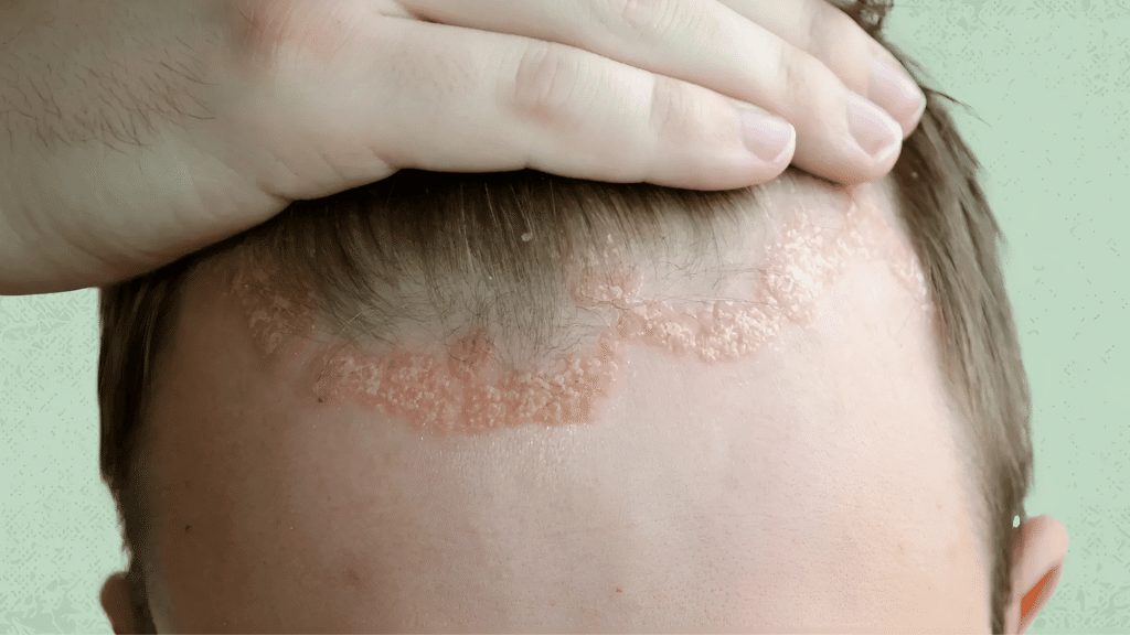 eczema