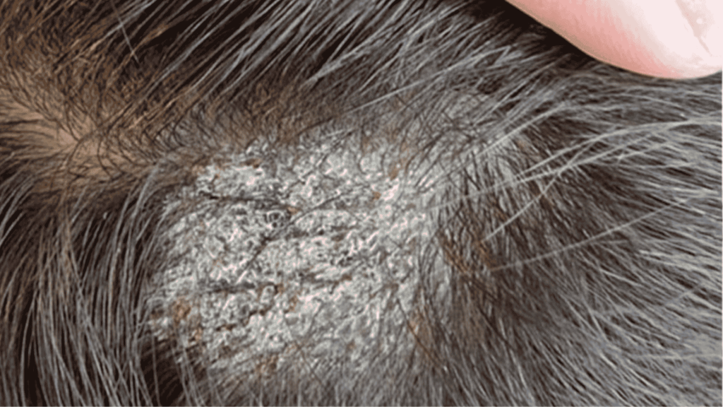 fungal infections