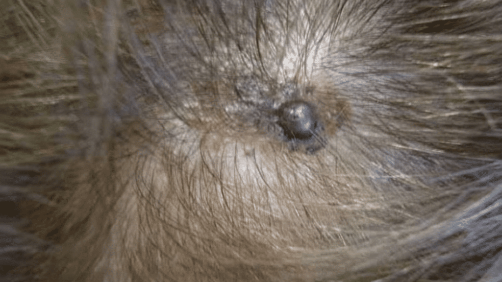melanoma on the scalp