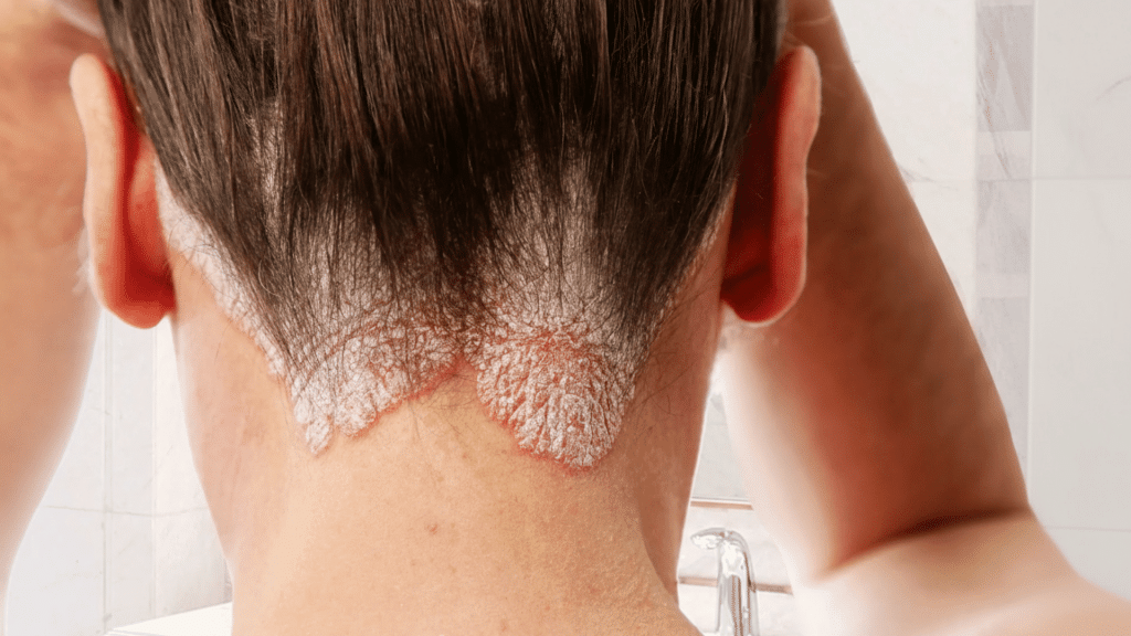 psoriasis