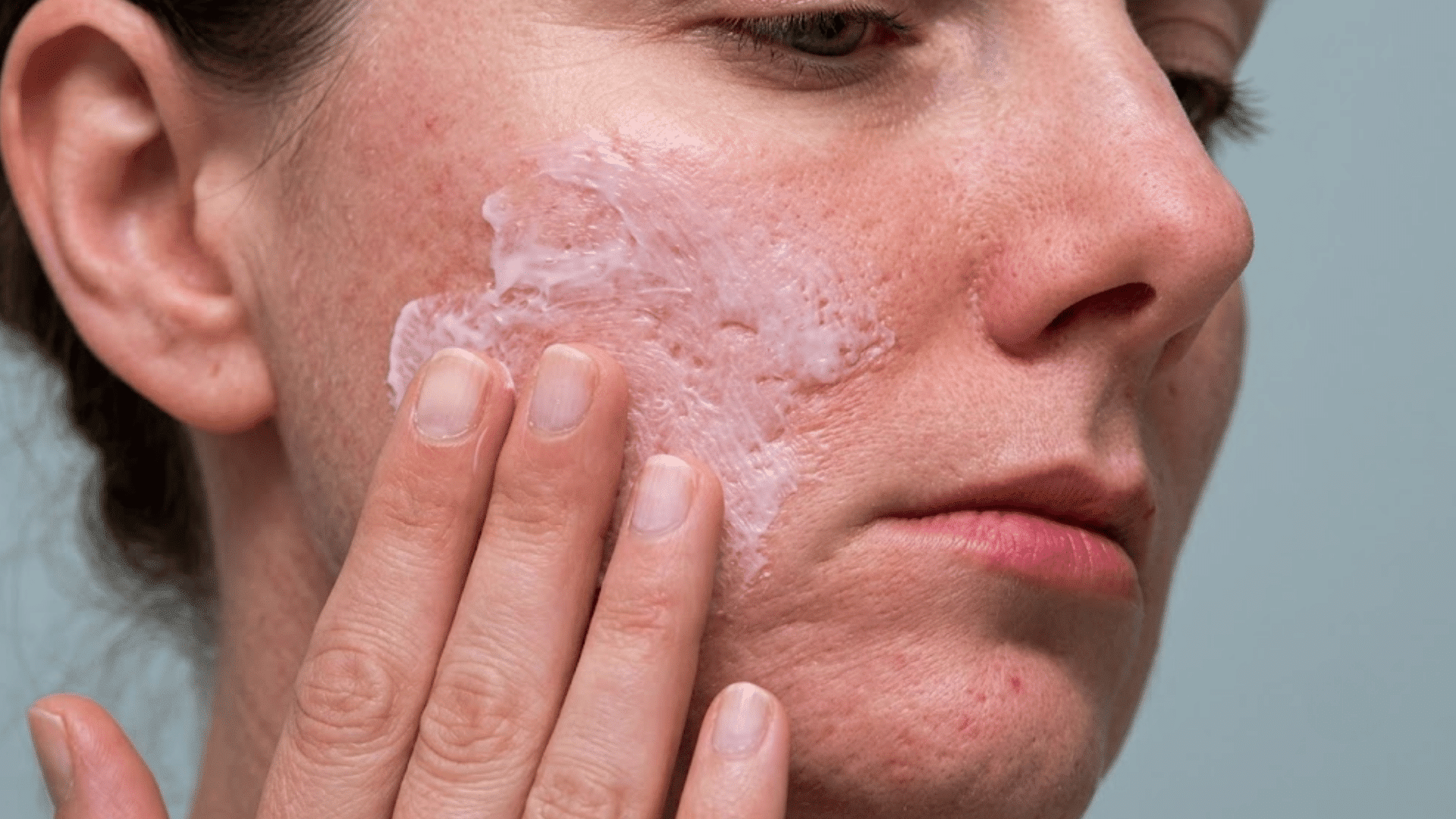 woman applying moisturizer to acne-prone skin after skincare treatment with visible post-acne marks