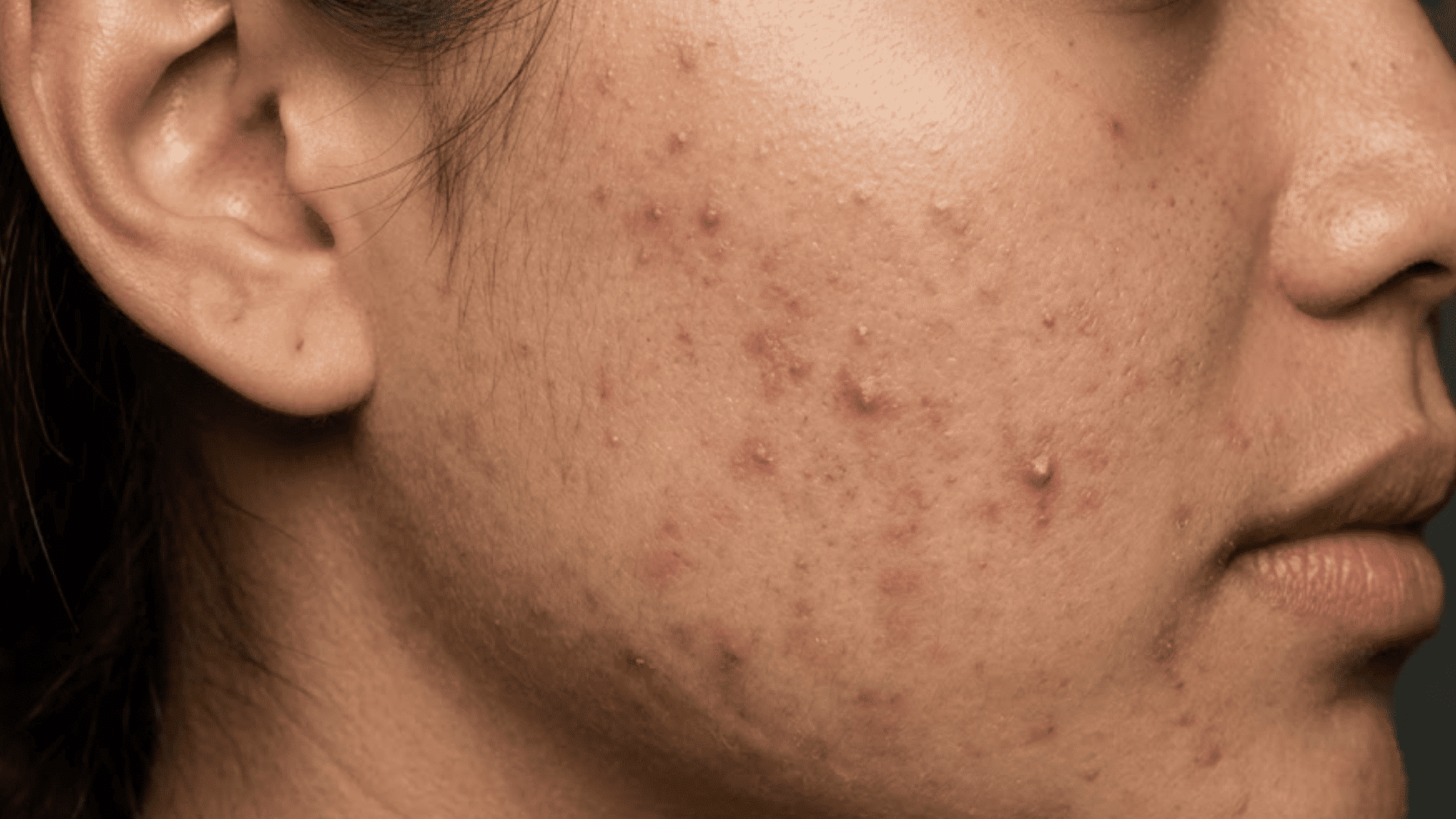 Close-up of active acne and dark post-inflammatory marks on a person's cheek, jawline, and lower face