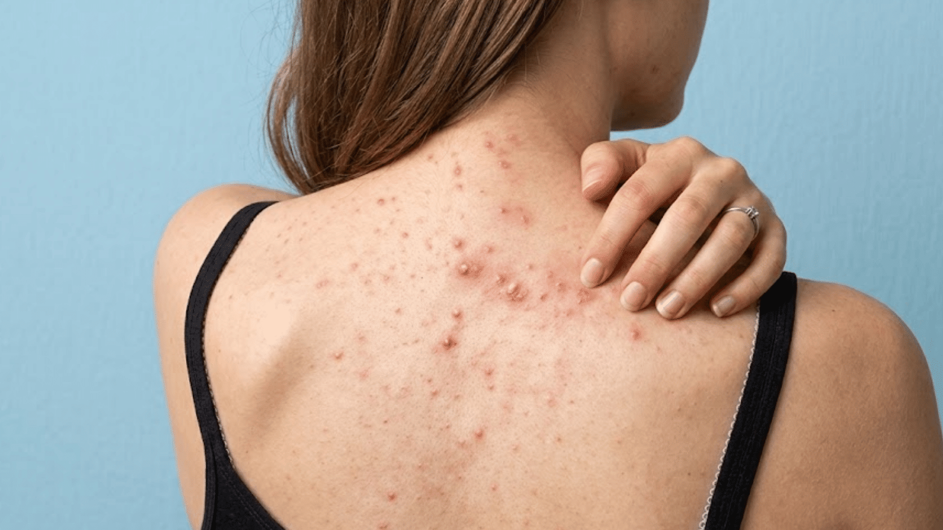 close-up of active acne spots and dark post-inflammatory marks across a person's upper back and shoulders