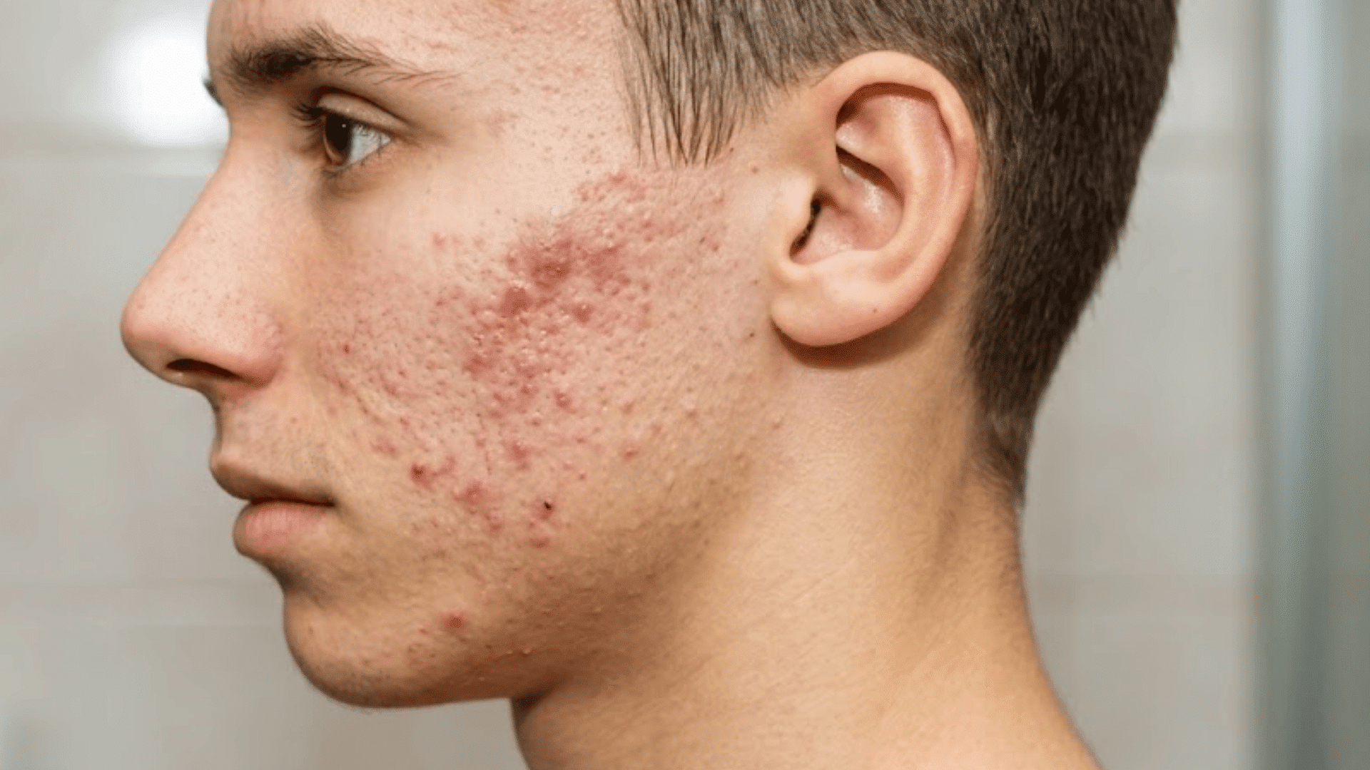 side profile of a young man with visible red acne and pimple marks across his cheek, jawline, and temple