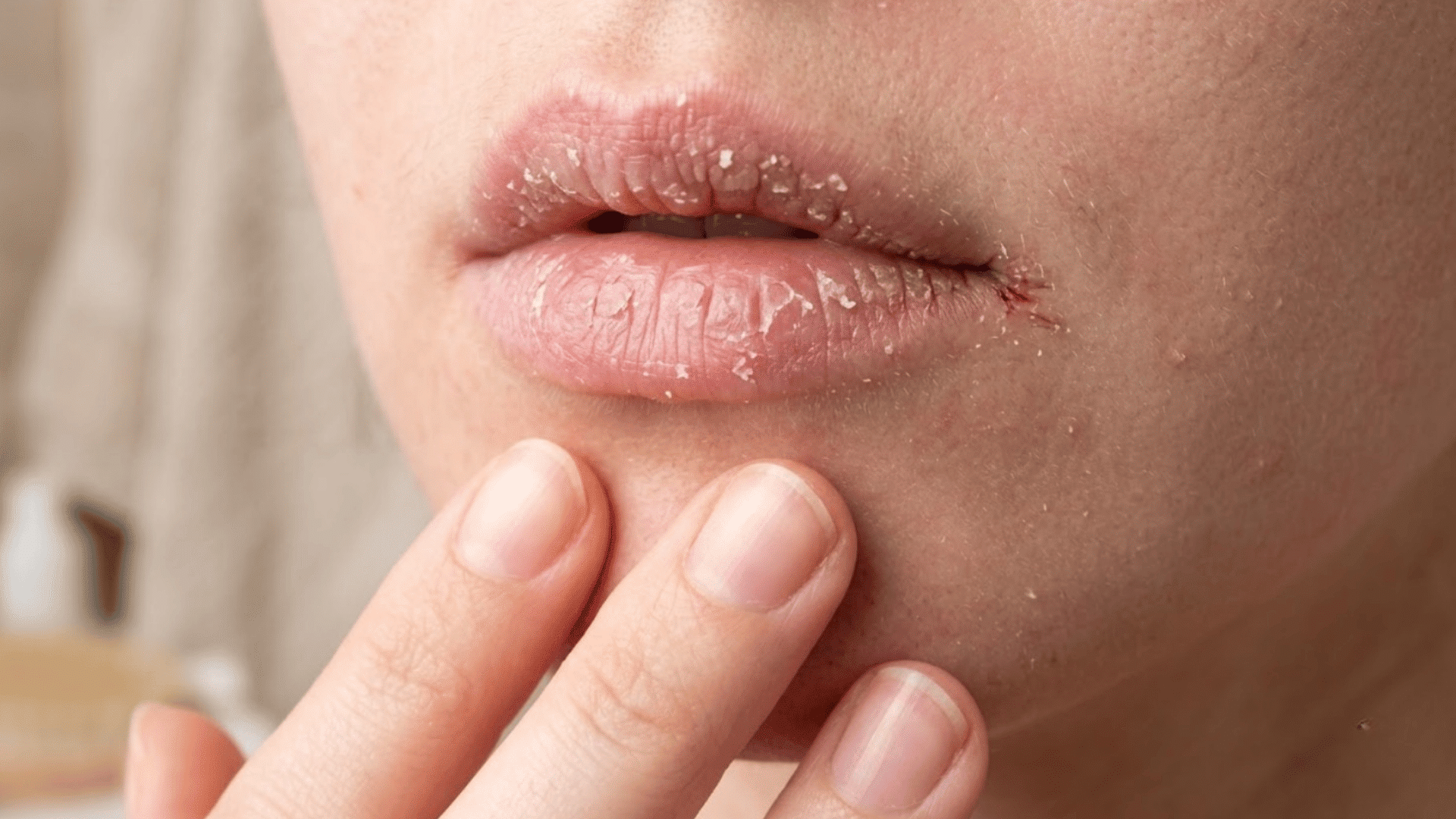 close-up of dry, cracked, flaky lips as a person gently touches the skin below the mouth with two fingers