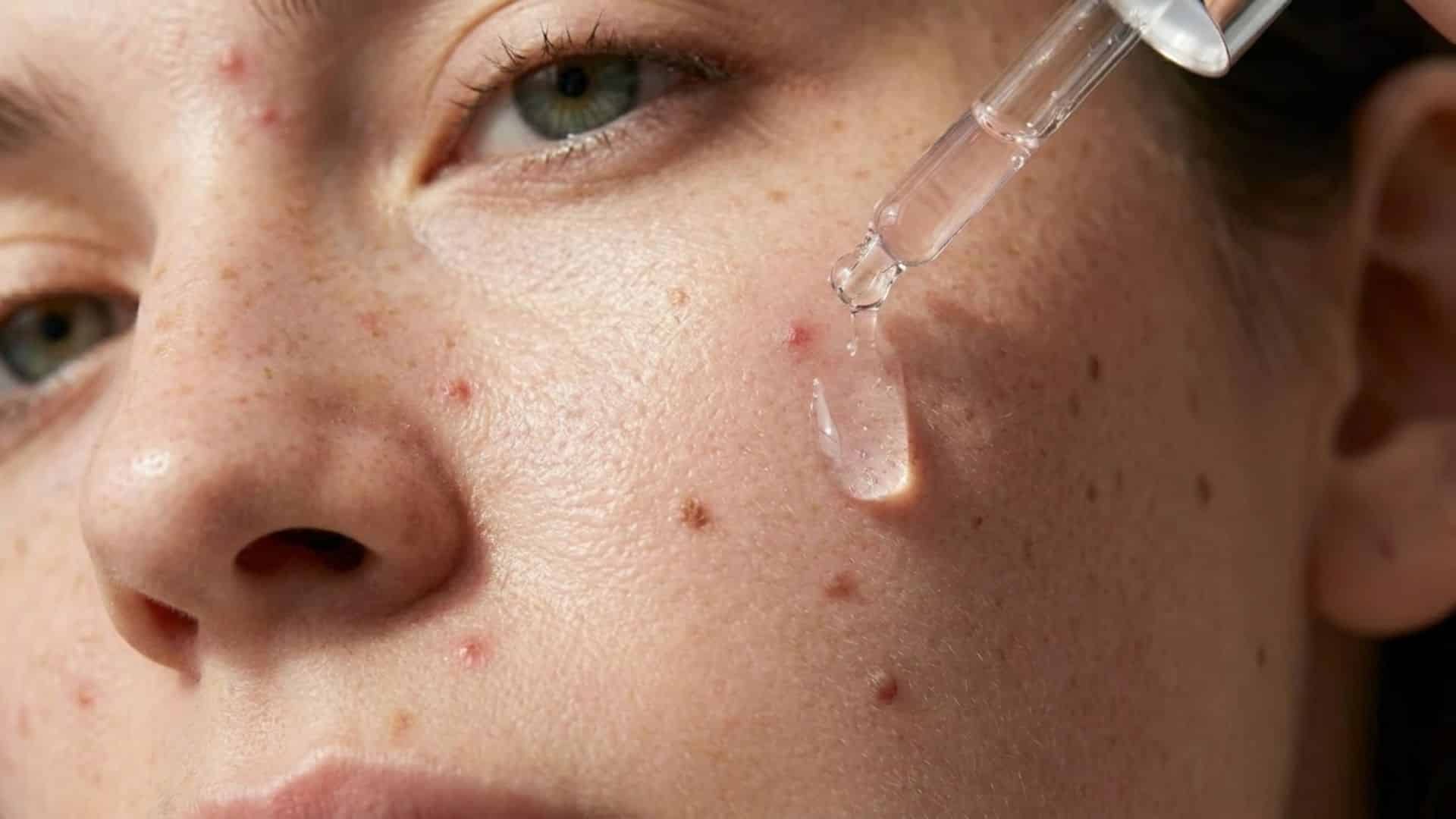 woman using hyaluronic acid on a slightly acne prone face