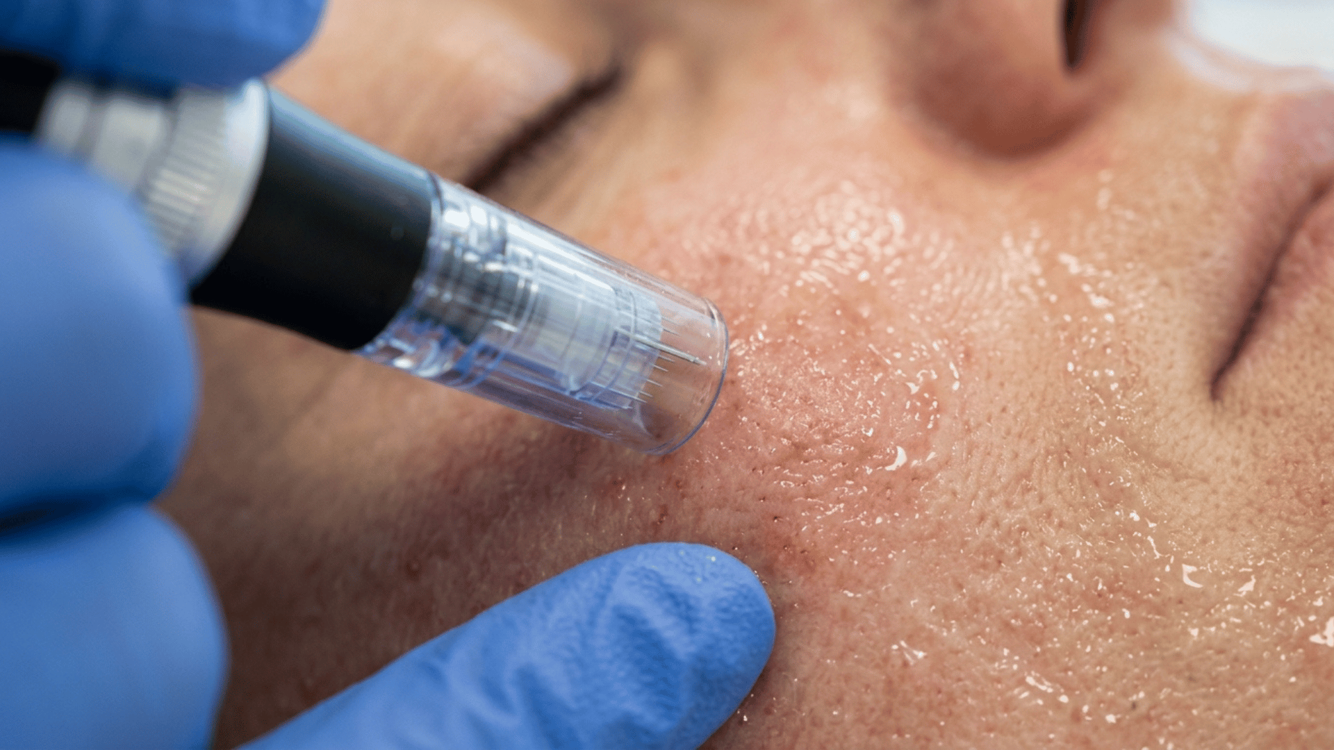 close-up of a microneedling device being used on facial skin during a treatment session