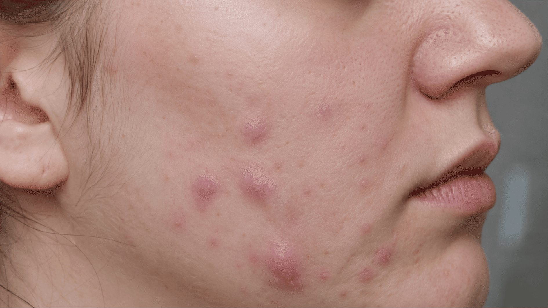 close up of <echighlighted><echighlighted><echighlighted><echighlighted>nodular acne</echighlighted></echighlighted></echighlighted></echighlighted> on the cheek showing red, inflamed bumps under the skin