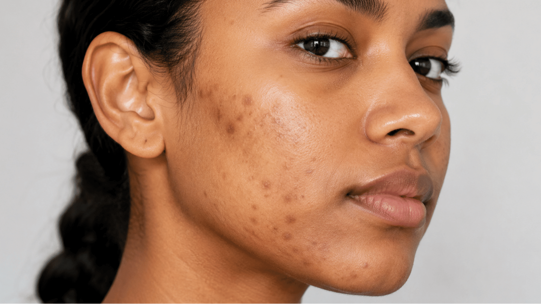 close up of a woman with flat brown post inflammatory hyperpigmentation spots visible across her cheek and jawline skin