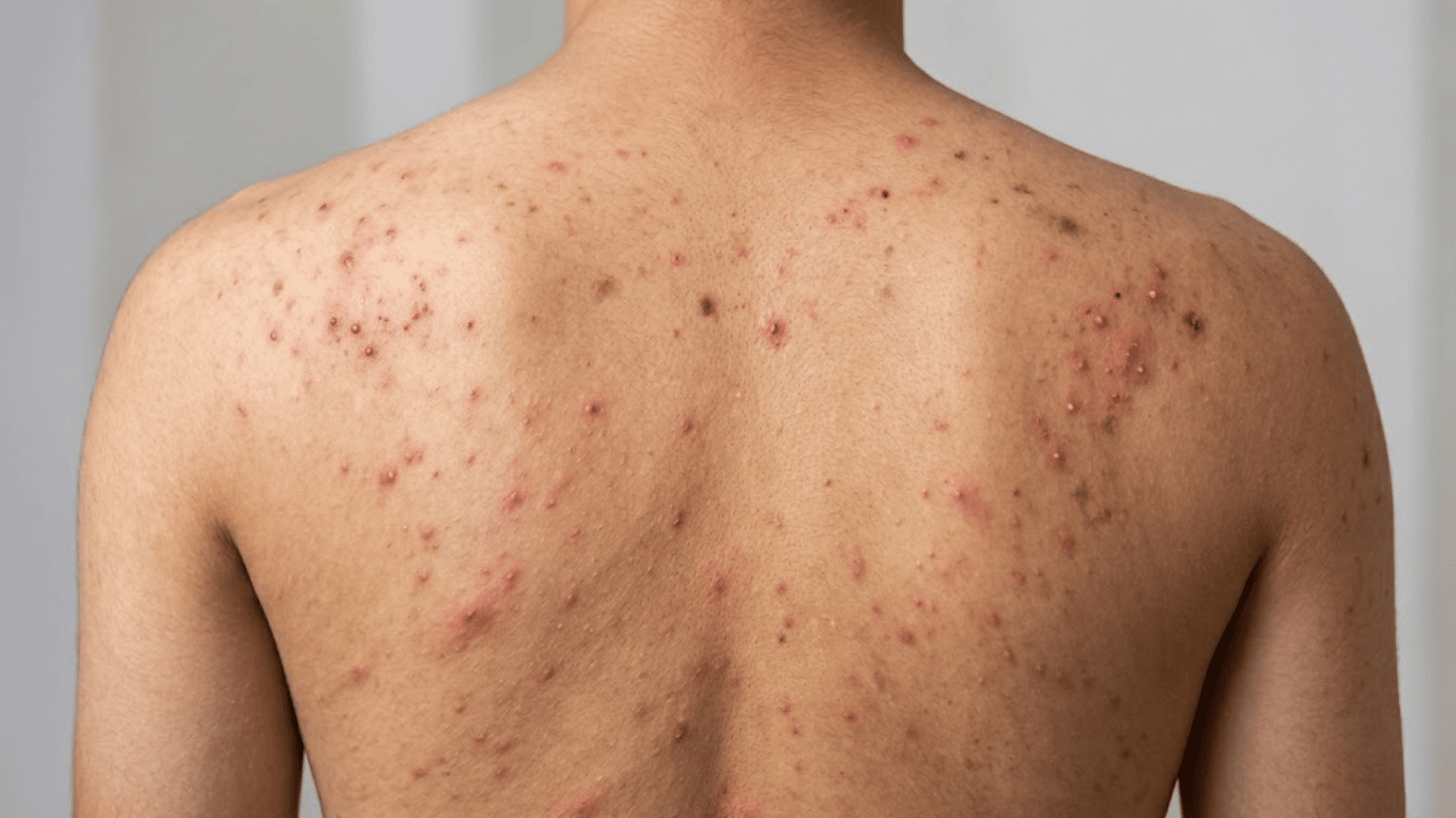 upper back with red acne bumps, pimples, and dark marks spread across the shoulders and shoulder blades