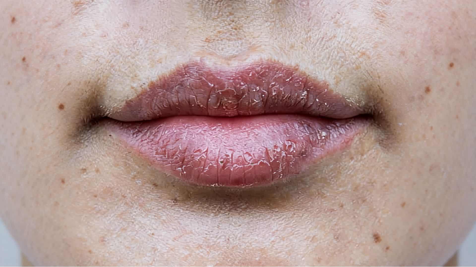 close-up of severely dry, cracked, and peeling lips with visible flaking across the upper and lower lip