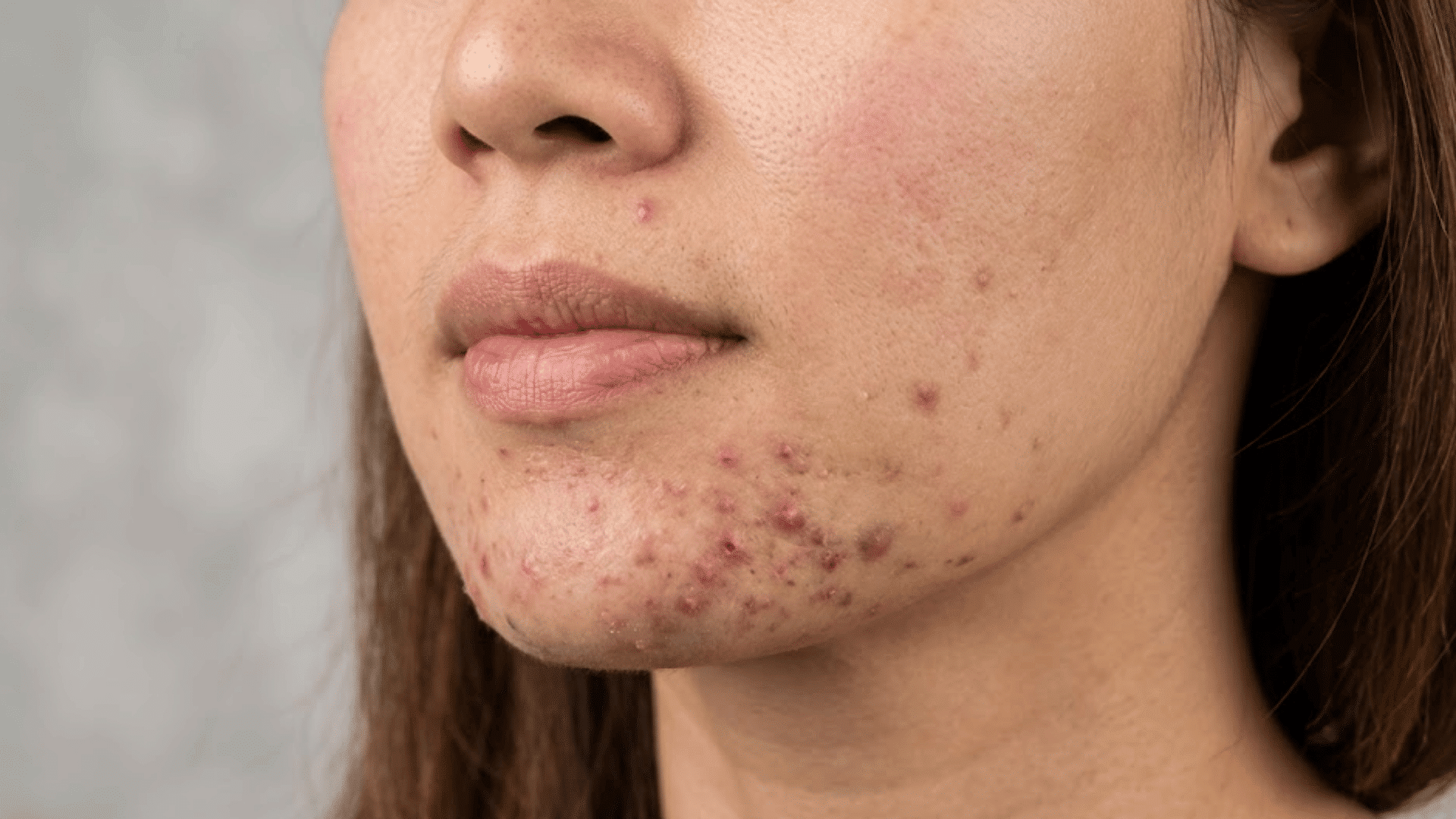 close-up of a woman with acne, red pimples, and dark marks visible across the chin and lower cheek area