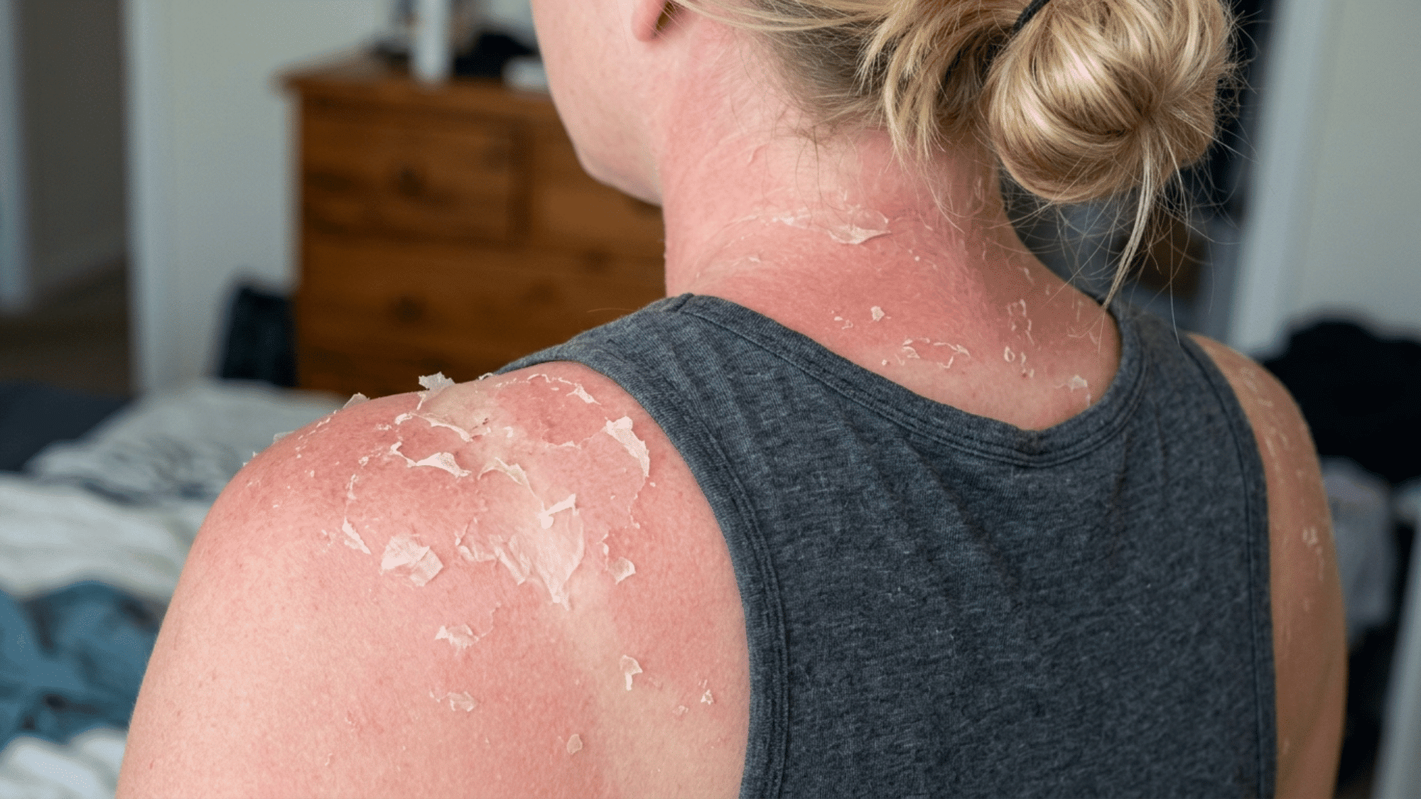 person with peeling sunburn on the shoulder and neck showing flaking skin during the natural healing process