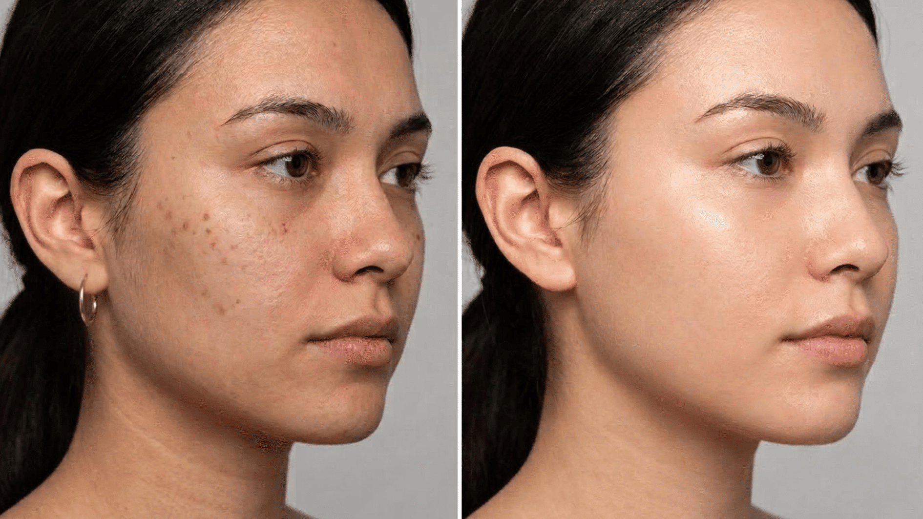 before and after side-by-side of woman's cheek showing dark spots and uneven tone fading to brighter, even-toned skin after vitamin c serum use