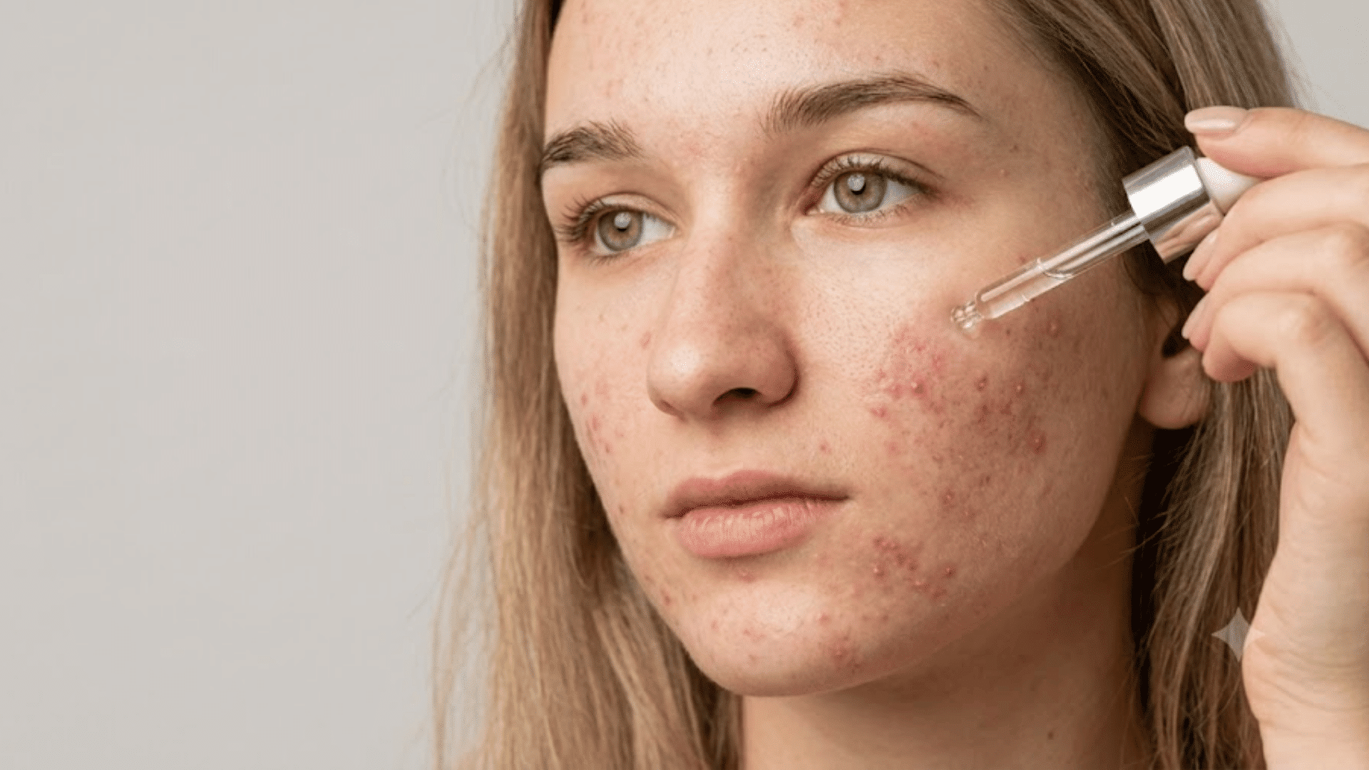 woman applying vitamin c serum to acne-prone skin with visible facial breakouts during skincare routine