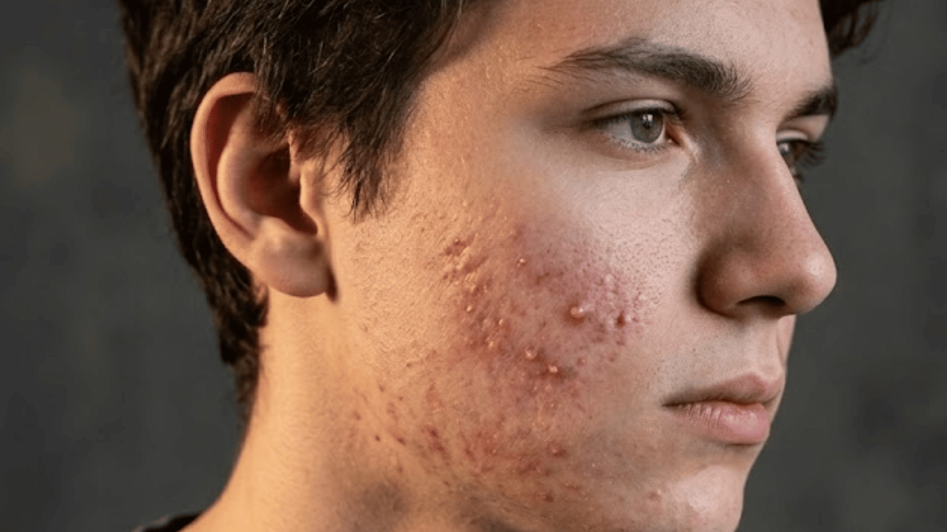 young man with visible acne and redness on his cheek, shown in side profile against a dark background